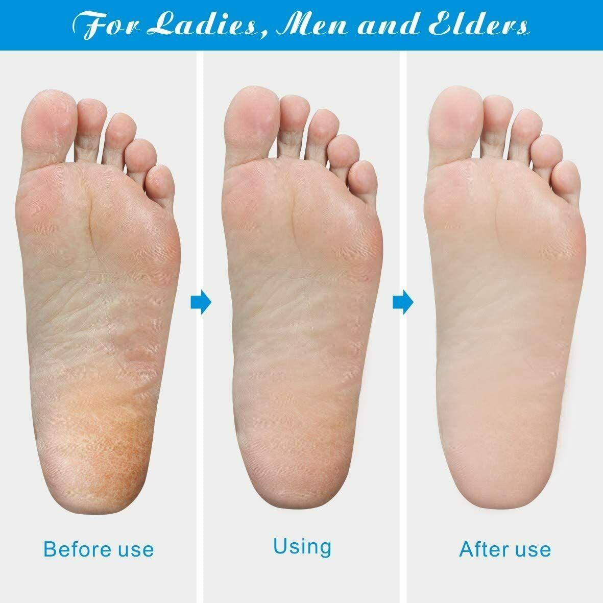 Foot Rasp File Callus Remover Pedicure Tool Dead Hard Skin Scraper Scrubber Tool